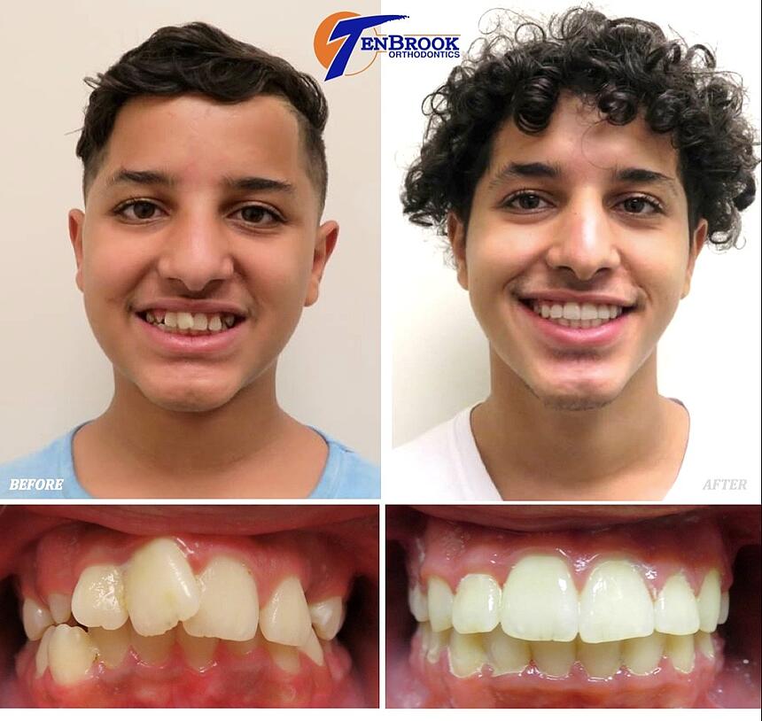 Braces Under Bite Adult Before And After